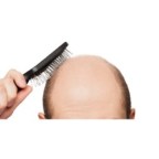 Global OTC Hair Loss Treatments Market 2019 Merck, J&J, Taisho Pharma, Costco Wholesale, Wal-Mart, Bayer